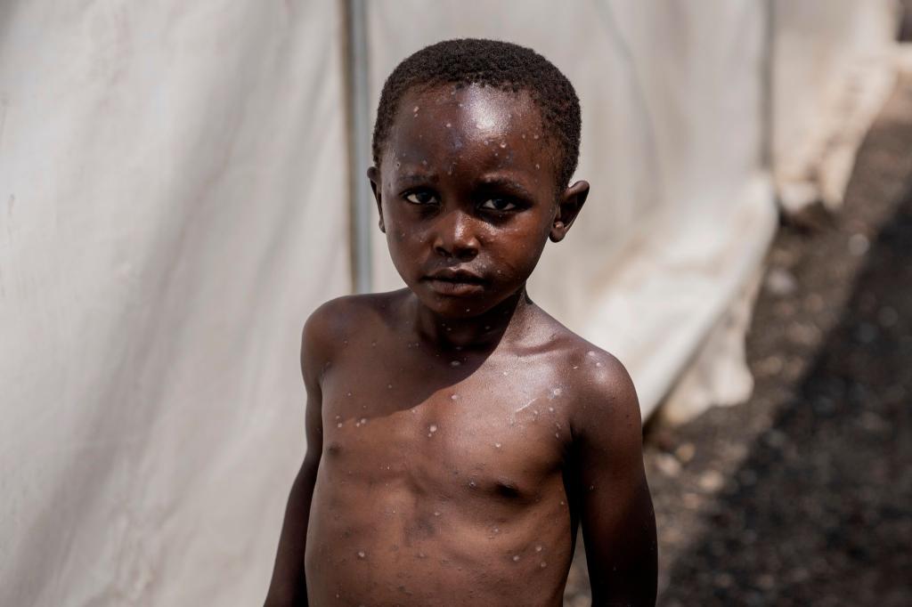 Für Kinder und immungeschwächte Menschen kann die Krankheit tödlich sein. (Archivbild) - Foto: Moses Sawasawa/AP/dpa